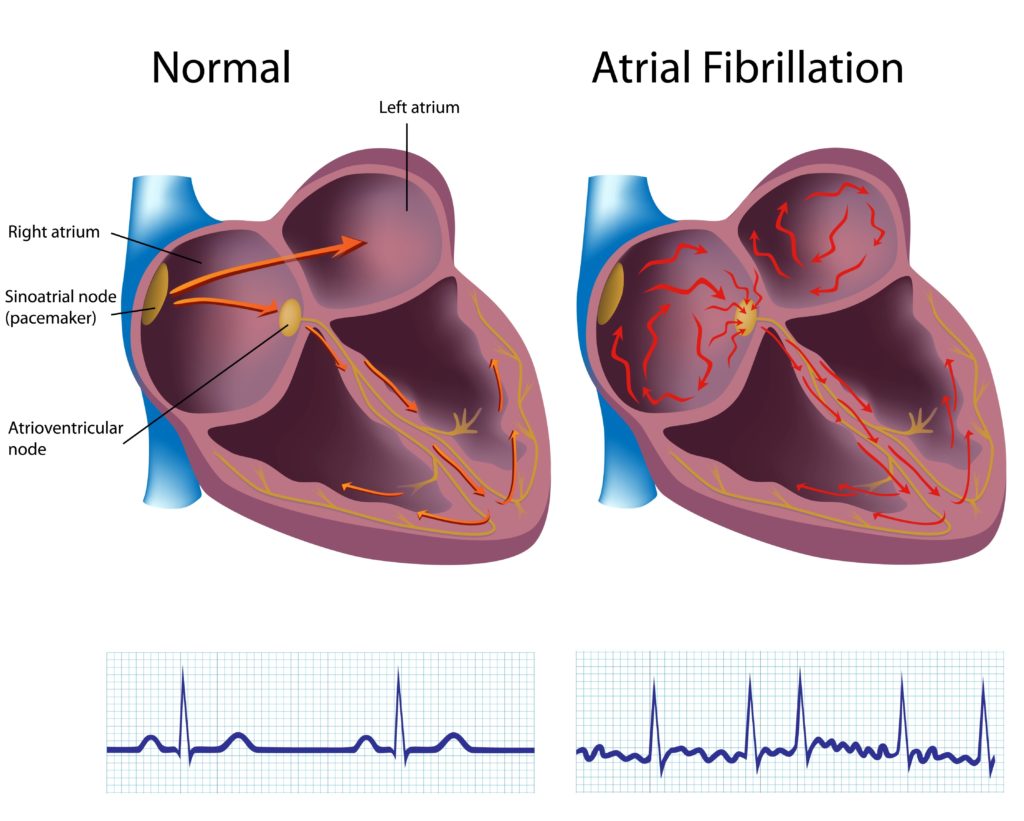 Atrial Fibrillation : Carolina Heart and Leg Center