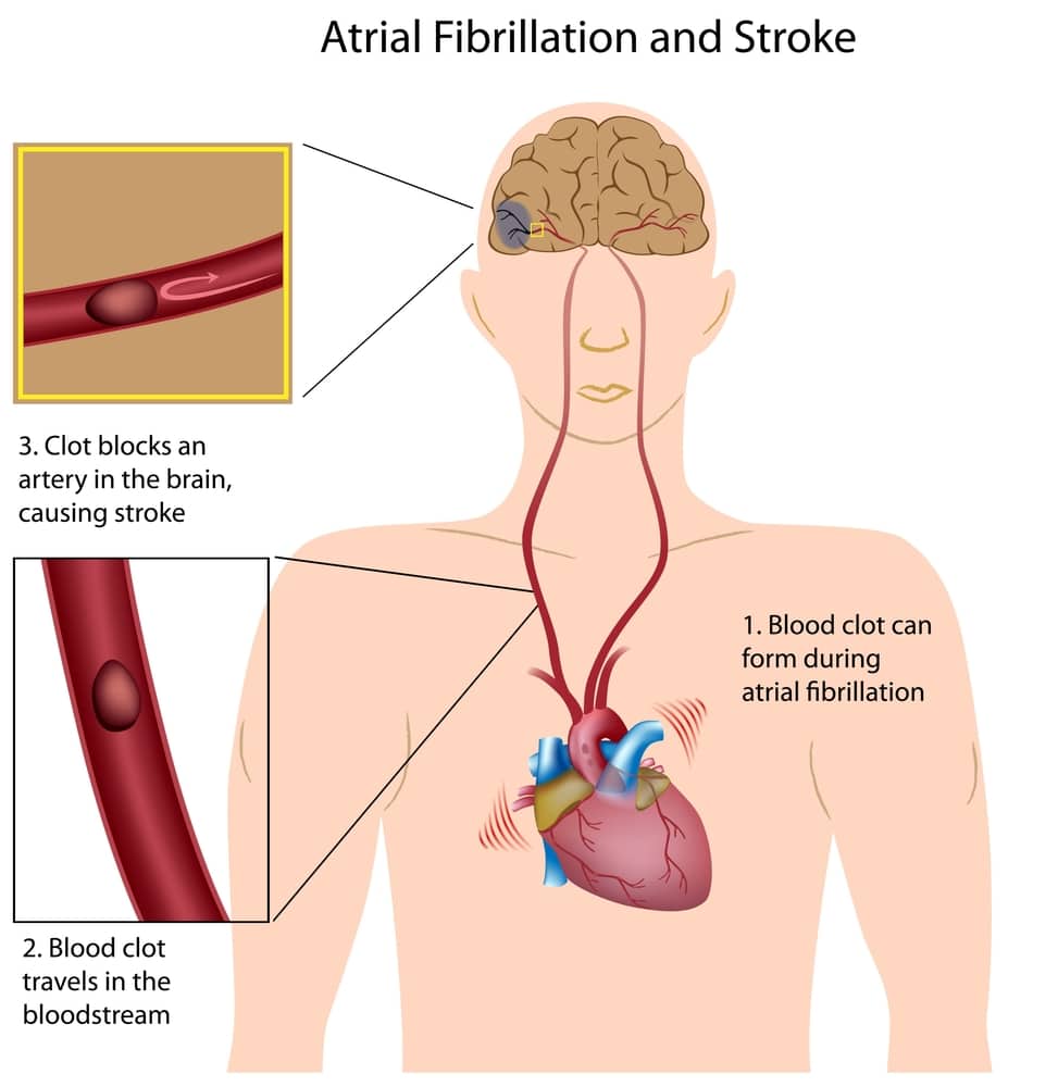 Atrial Fibrillation