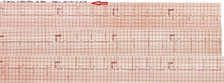 Can Anxiety Cause Ekg To Be Abnormal