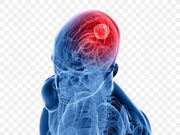 Can you survive a brain tumor?