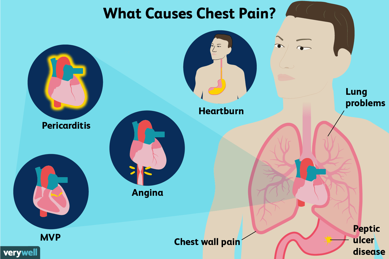 Chest Pain Causes Treatment And When To See A Doctor