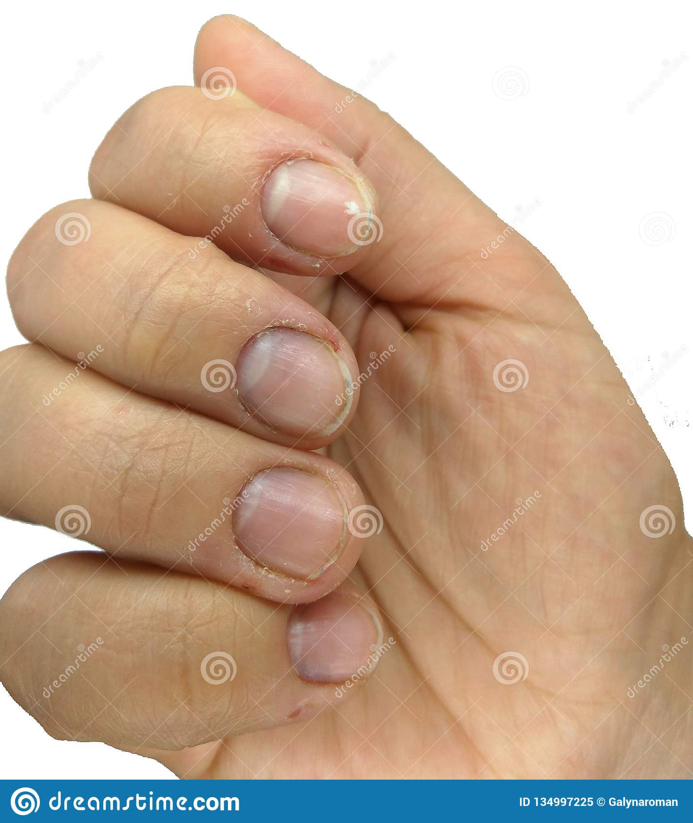 Damaged Nervous Nails, Biting Nails on Fingers Stock Image