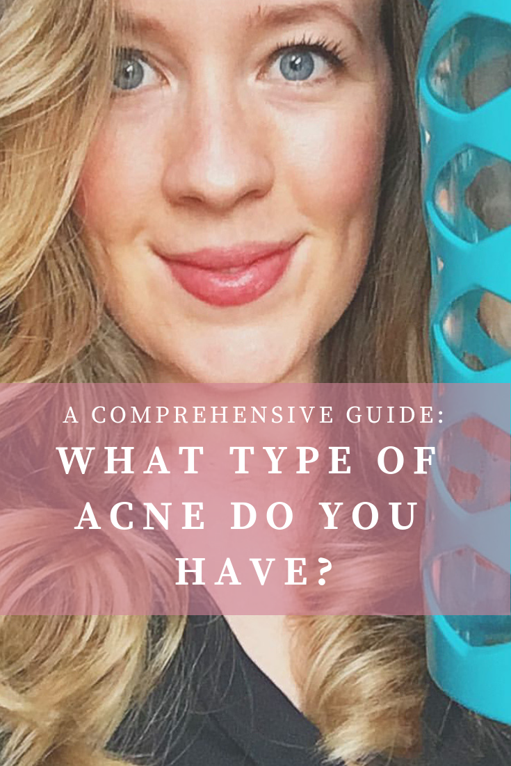 Do I have hormonal acne, stress acne, or dietary acne ...