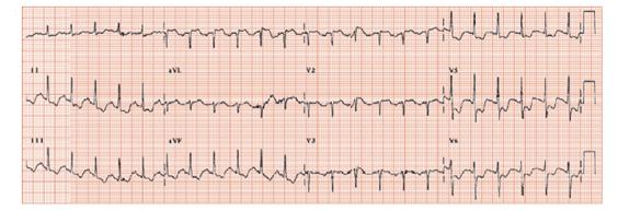 Emotion And The Ecg Thoracic Key