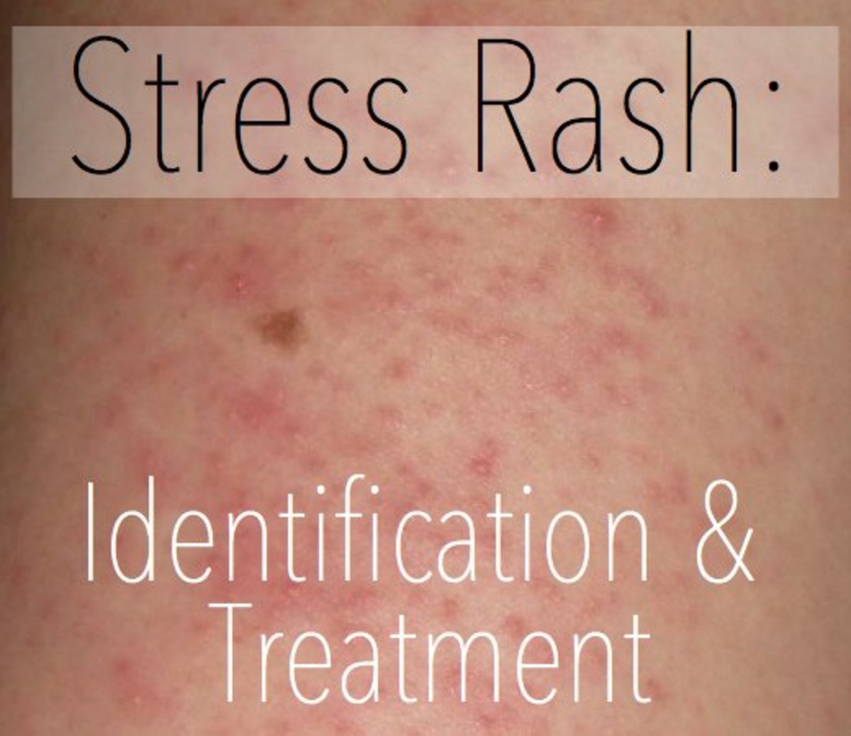 Stress Rash: Causes, Symptoms, Pictures, &  Treatment ...