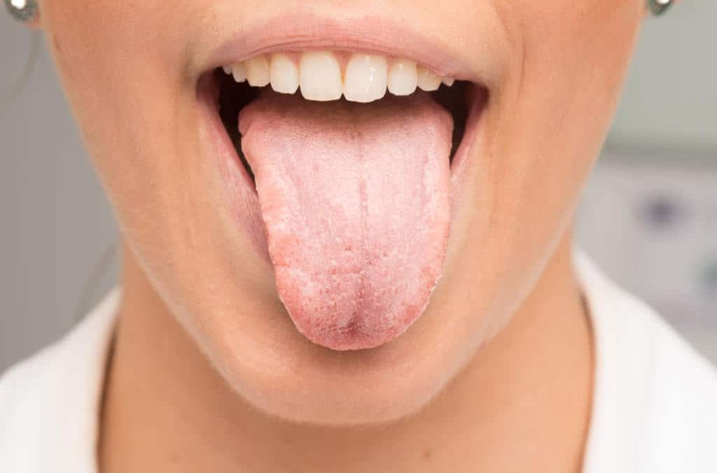 Top 5 Reasons You Have Dry Mouth