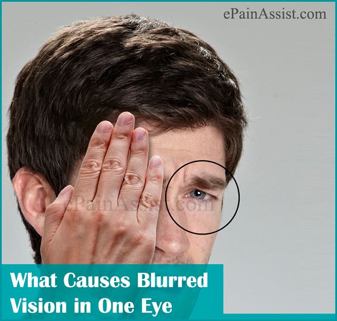What Causes Blurred Vision in One Eye &  How is it Treated