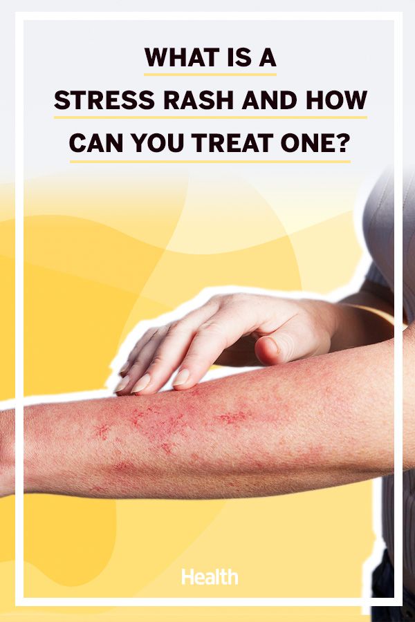 Your Rash Might Be Caused By StressHeres How to Tell ...